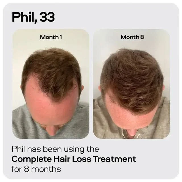 Sons Minoxidil Treatment 6 Month Value Bundle - Image 8