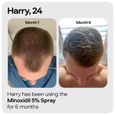 Sons Minoxidil 5% Spray 1 Month - Image 4