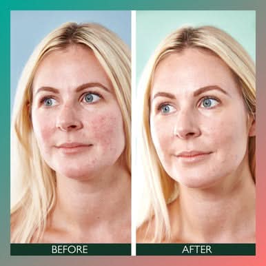 Sorted Skin 5 in 1 Anti-Redness Day Cream SPF50 30ml - Image 4